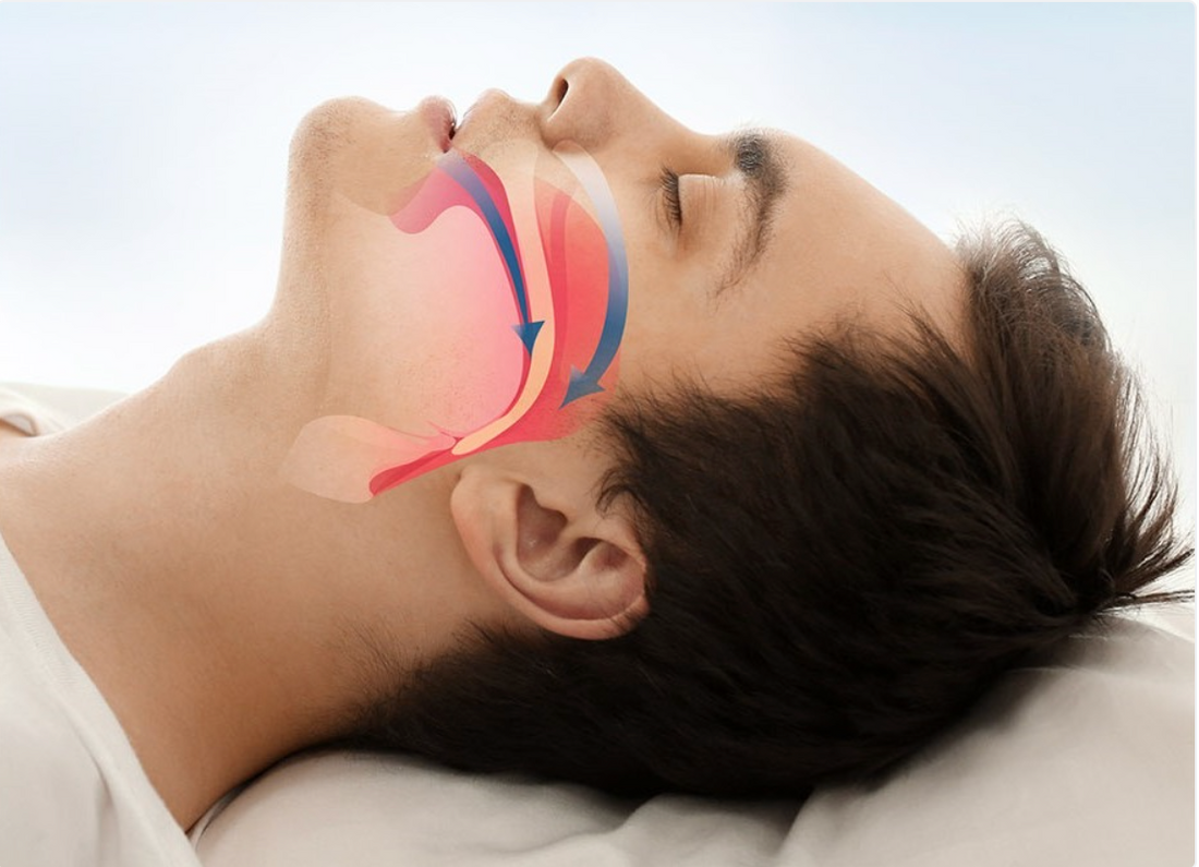 TMJ and Sleep Apnea: Understanding the Connection and Finding Relief