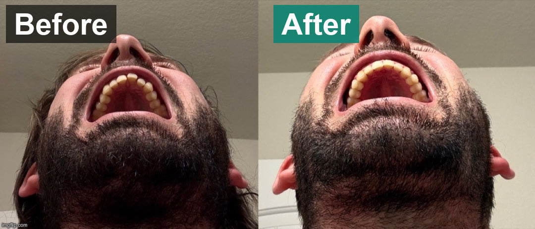 Lower teeth crowding