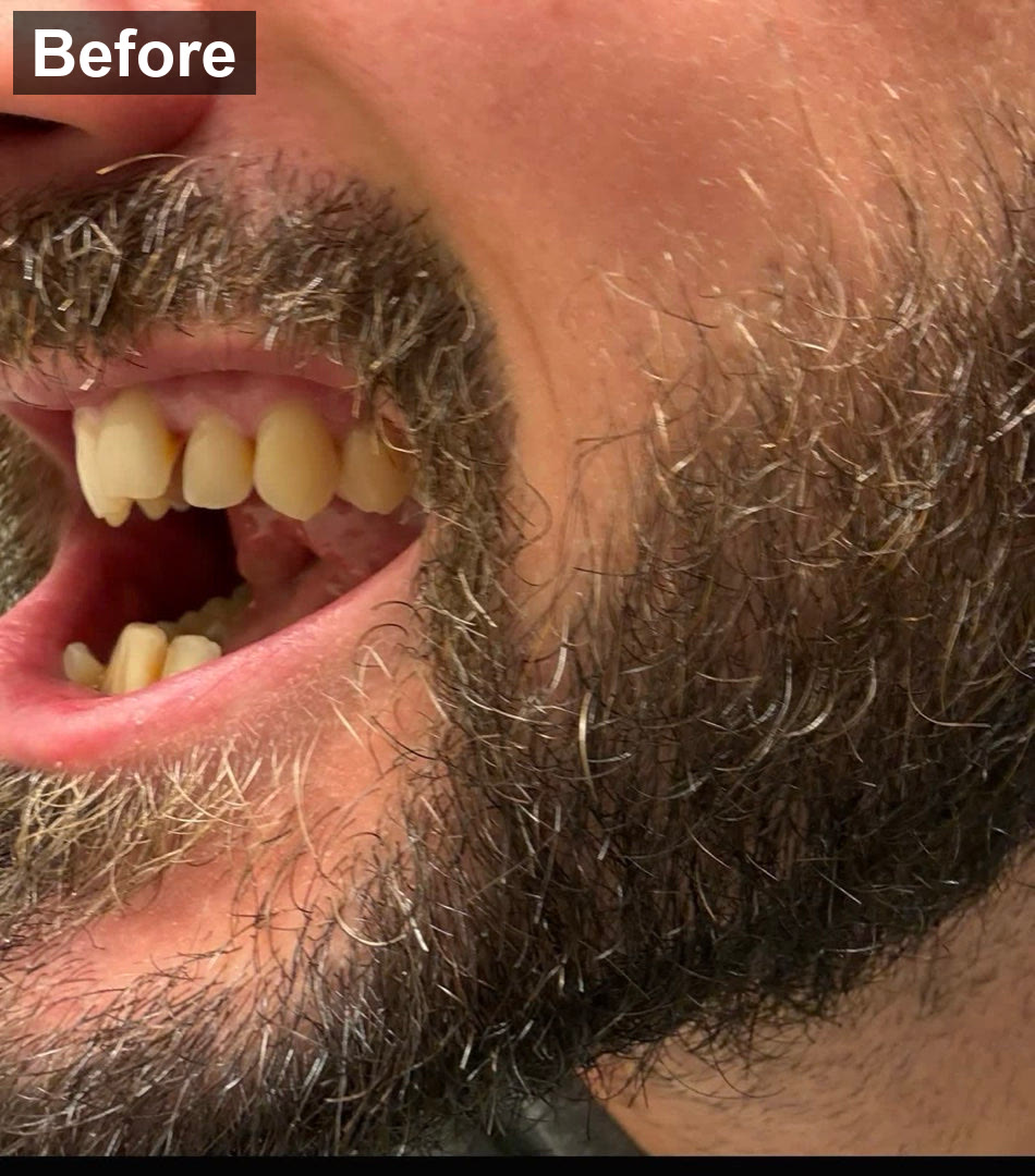 The snaggletooth, before and after