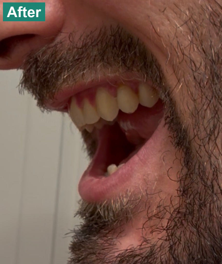 The snaggletooth, closer