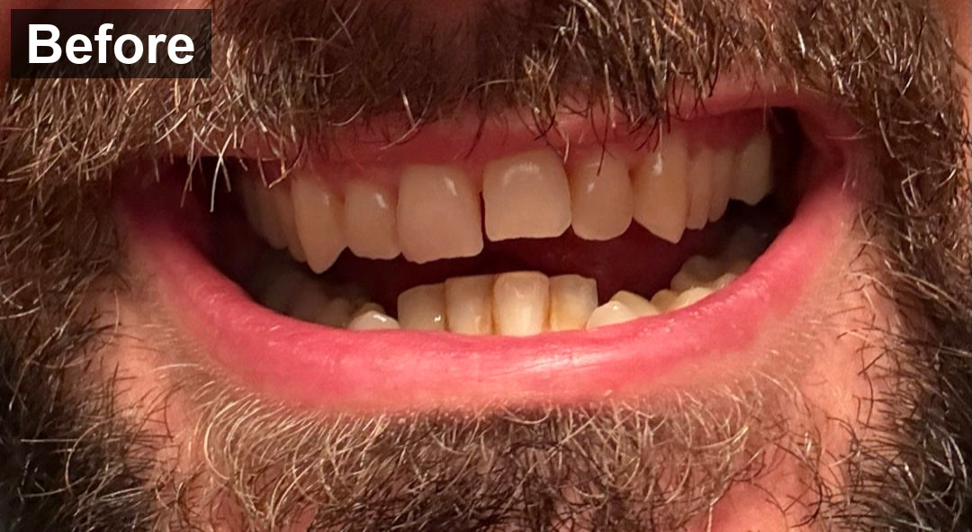Front teeth straight on