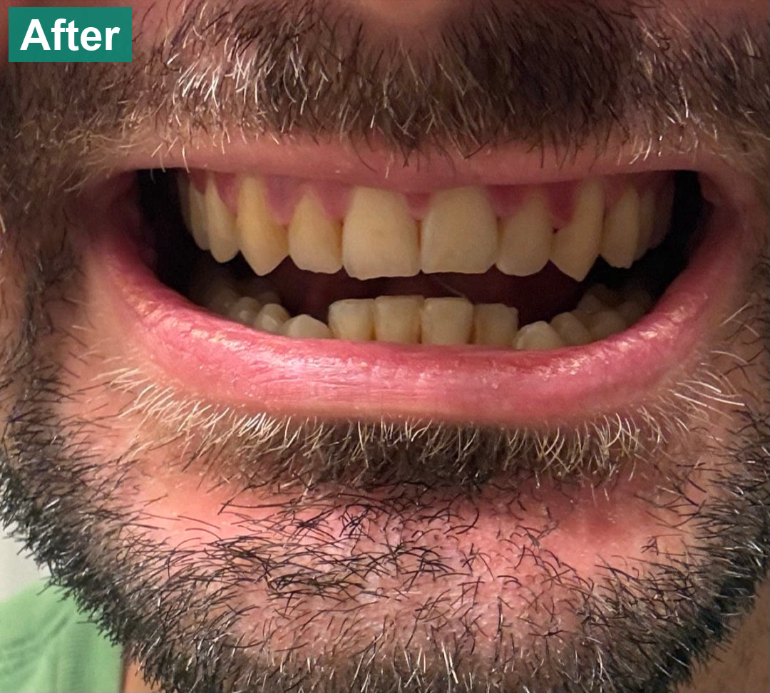 Front teeth, closer