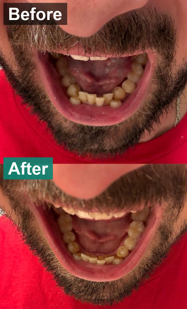 Front teeth top and bottom