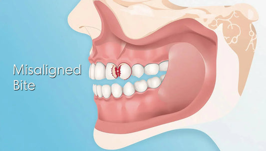 How a Misaligned Bite Contributes to TMJ Disorder