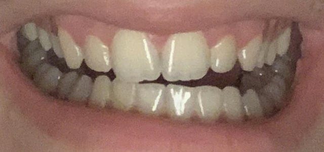 My bite is uneven... will a mouthguard help?