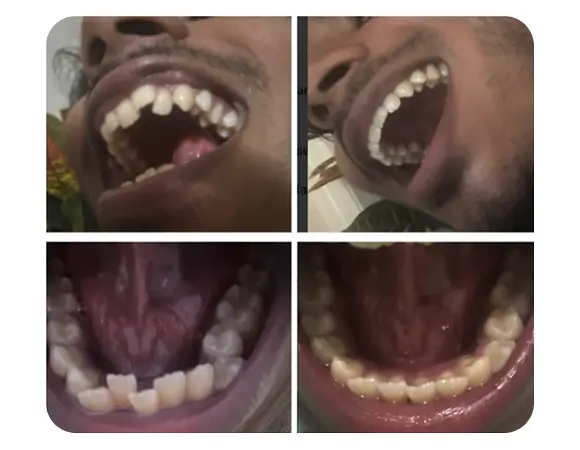 Teeth correction before and after