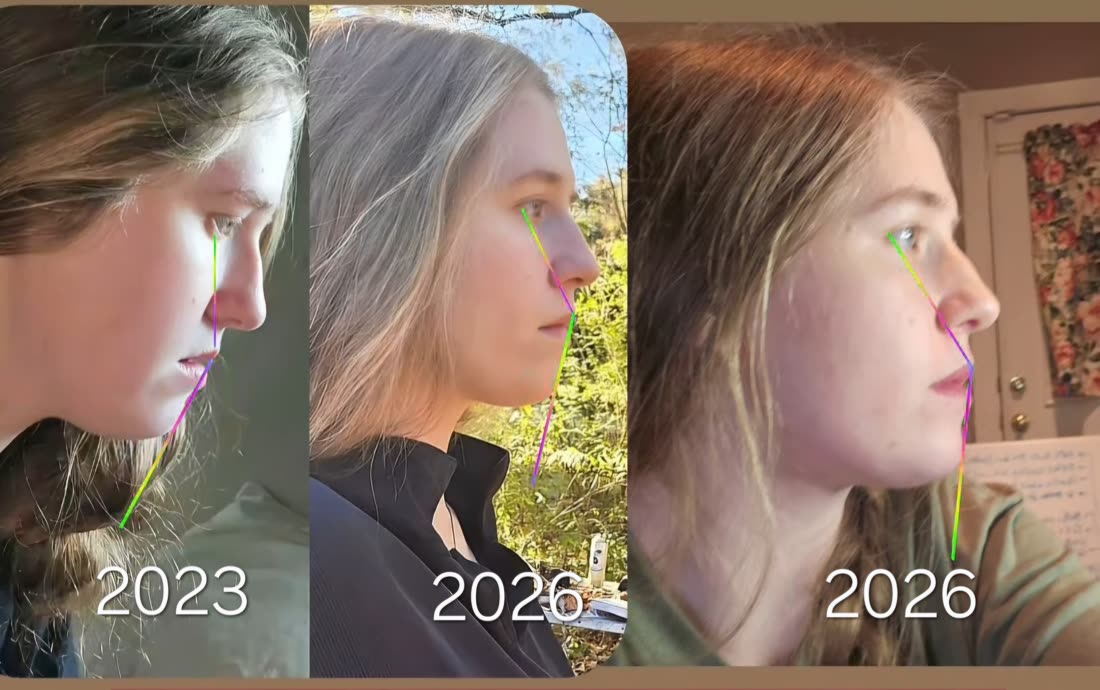 Side profile progression 2023 to 2026