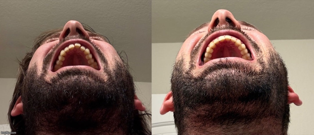 Lower teeth crowding