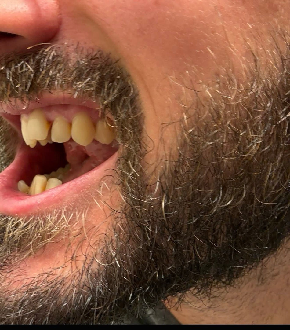 The snaggletooth, before and after