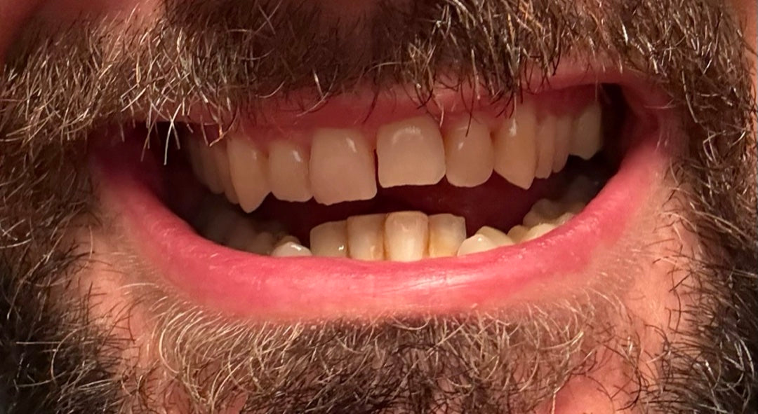 Front teeth straight on