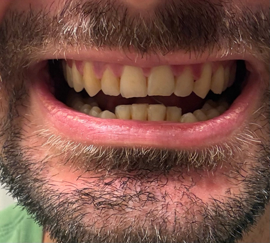 Front teeth, closer