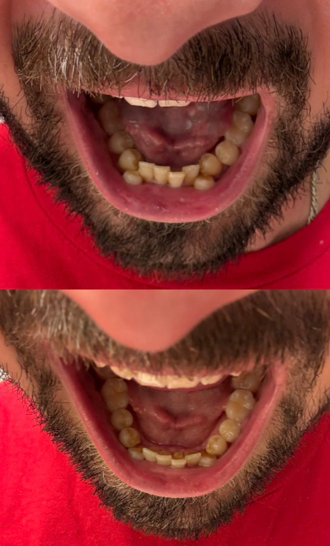Front teeth top and bottom